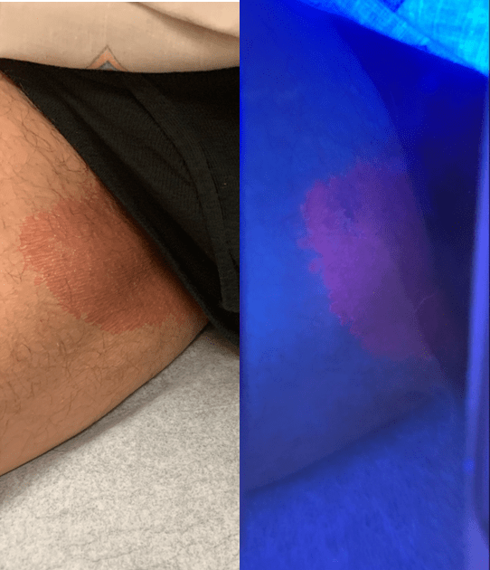 What Is This Rash on an Older Man’s Groin? Consultant360